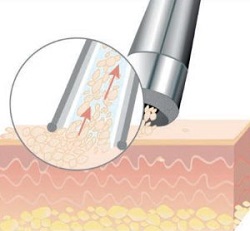 Mikrodermabrasion Gerät Test