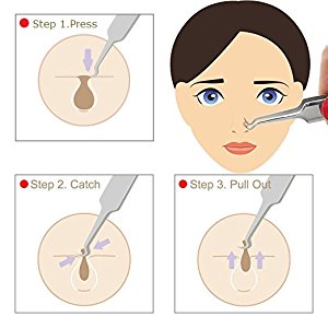 Mitesser entfernen für feine Poren